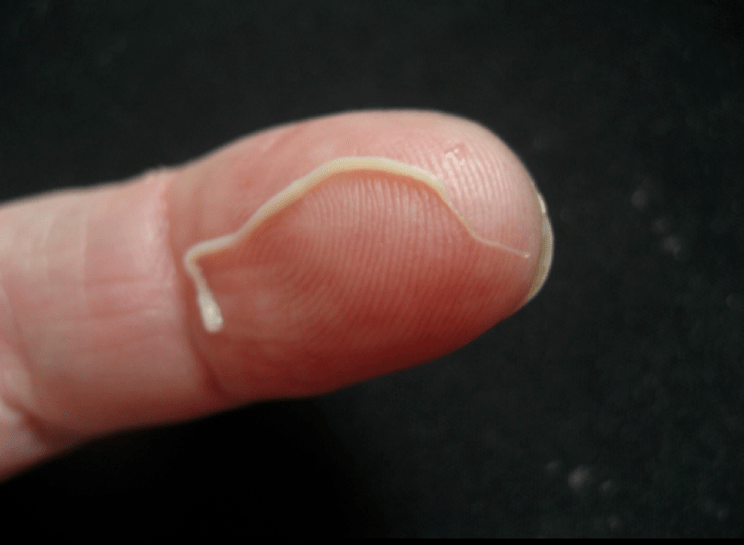 στρογγυλό παράσιτο από το ανθρώπινο σώμα